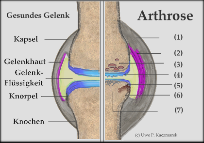 Deutsche Arthrose Stiftung - Arthrose - eine Bestandsaufnahme